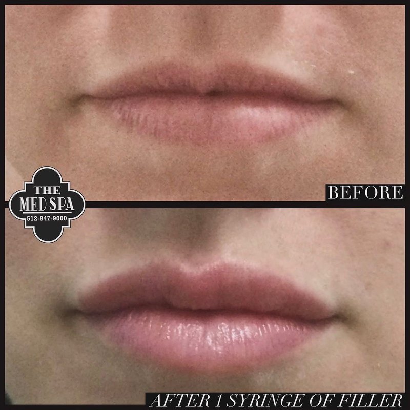 Lip filler before and after at The Med Spa Wimberley, one syringe of filler