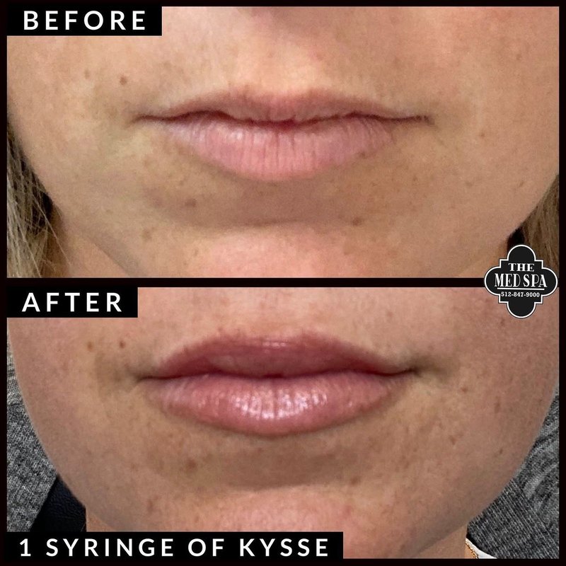 Lip filler before and after at The Med Spa Wimberley, one syringe of restylane kysse
