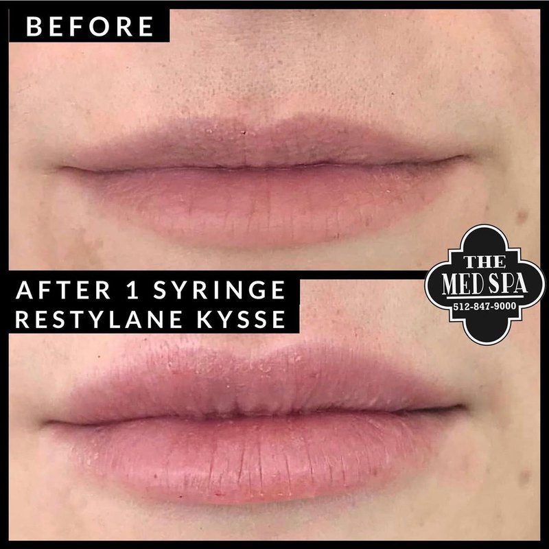 Lip filler before and after at The Med Spa Wimberley, one syringe of restylane kysse