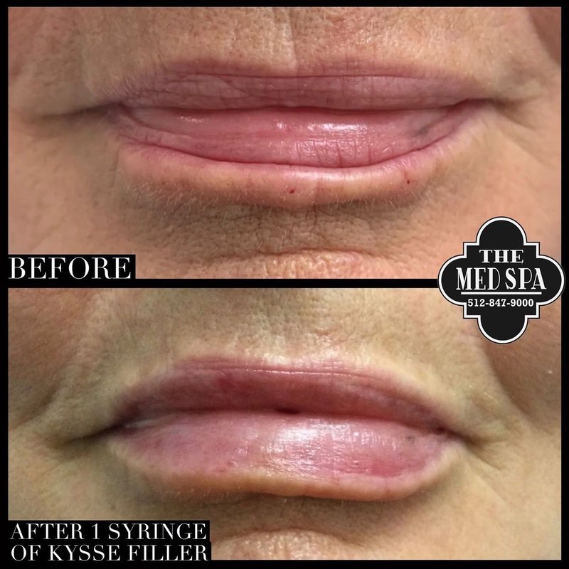 Lip filler before and after at The Med Spa Wimberley, one syringe of kysse filler
